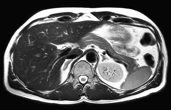 Axial T2w MultiVane XD (high res)